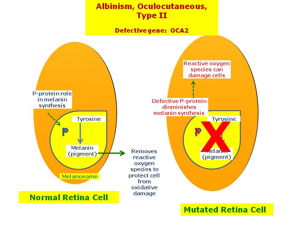 albinism-oculocutaneous-type-ii-hereditary-ocular-diseases